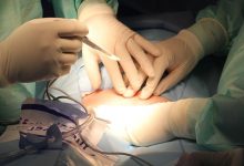 Despre operarea rinichilor